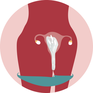 Sperm Guide at-home conception kit inserted into the vagina with panties hanging around upper thighs