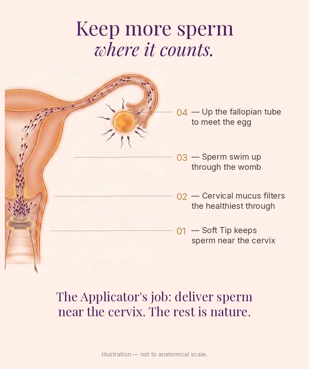 The Applicator delivers sperm near the cervix; cervical mucus filters the healthiest through